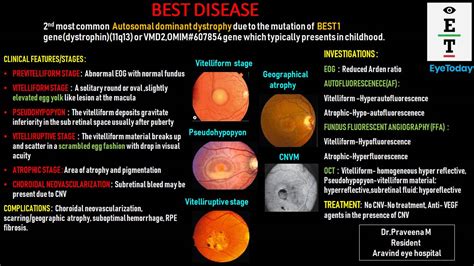 best disease eyes latest research.